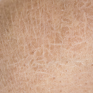 Macro dry skin (ichthyosis) detail