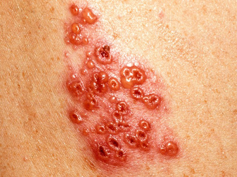 shingles rash