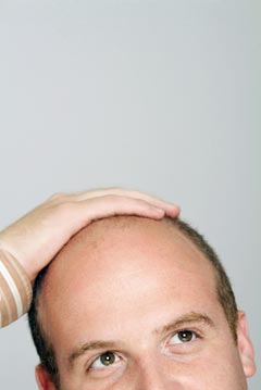 Baldness drug preventing prostate cancer