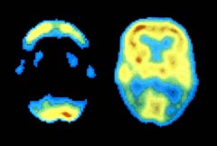 240-dementia-diabetes-study