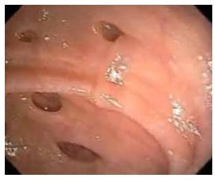 diverticula