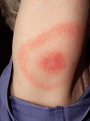 180-cdc-rash-lime
