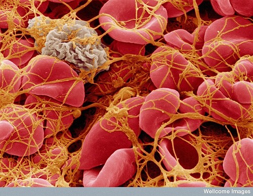blood clot