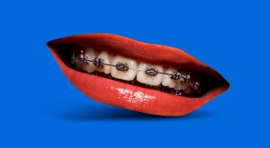 Braces,Close,Up,,Modern,Contemporary,Collage,Mouth,With,Braces,Smiling,