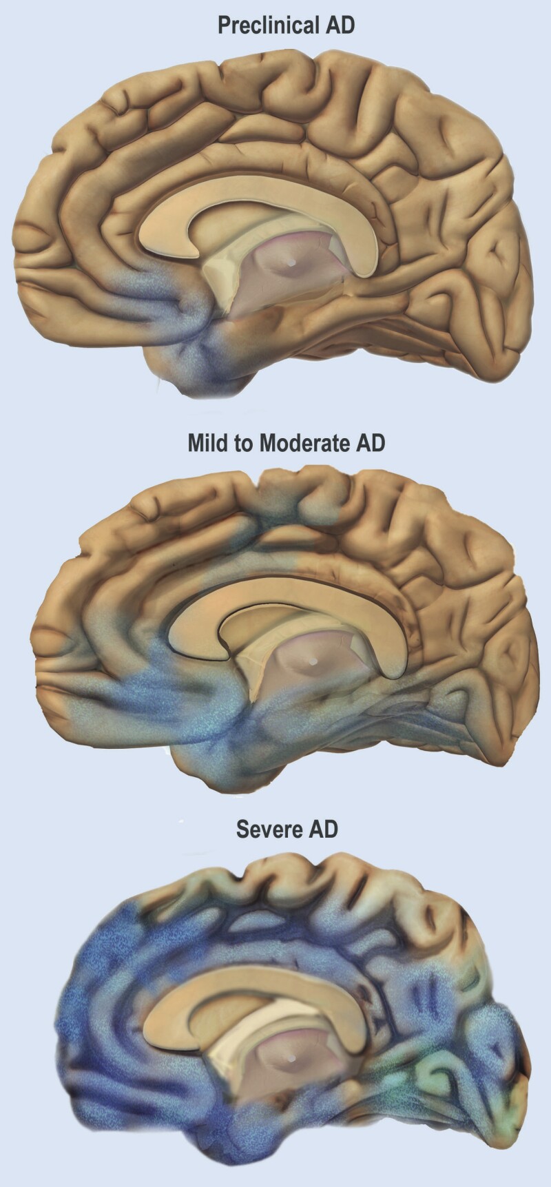 alzheimers
