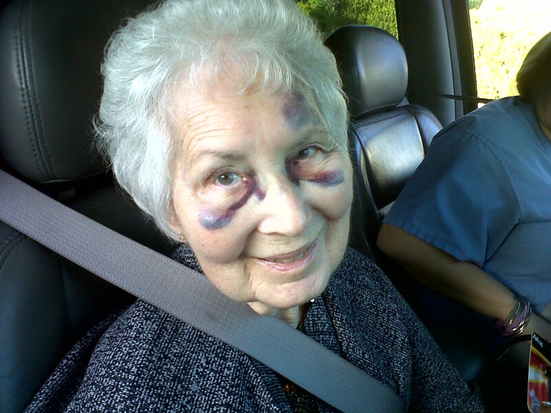 Mom fractured nose