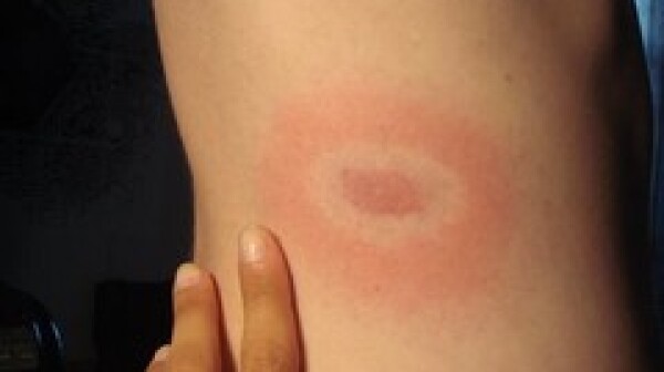 bullseye rash