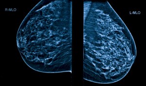 Mammogram screening with lump in one breast