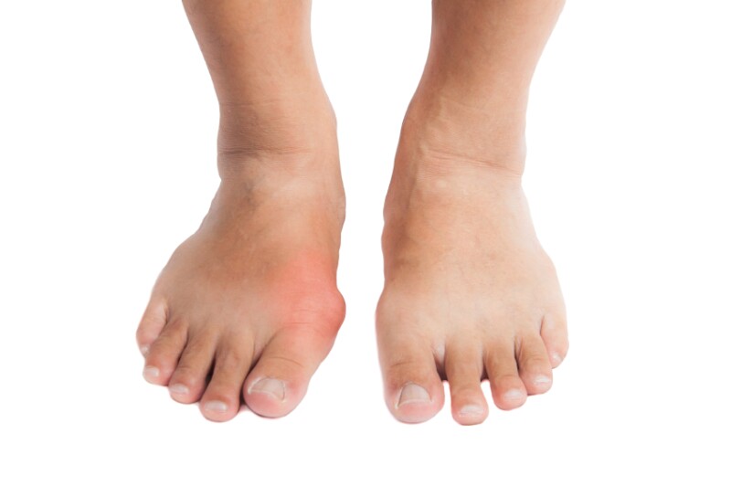 Feet - with Gout