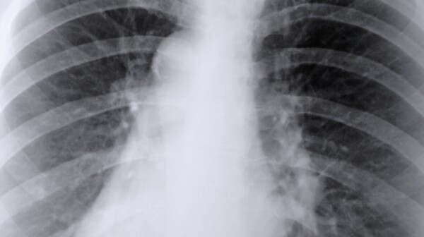 Thorax X-ray of the lungs
