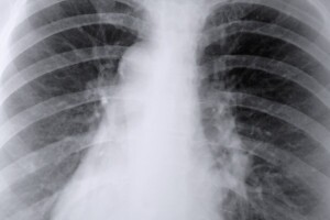 X-ray of the lungs