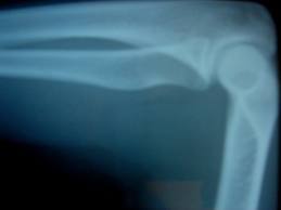 bone2