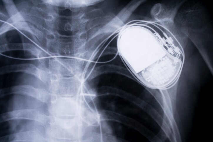 x-ray chest