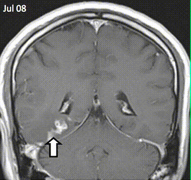 tapeworm inside brain