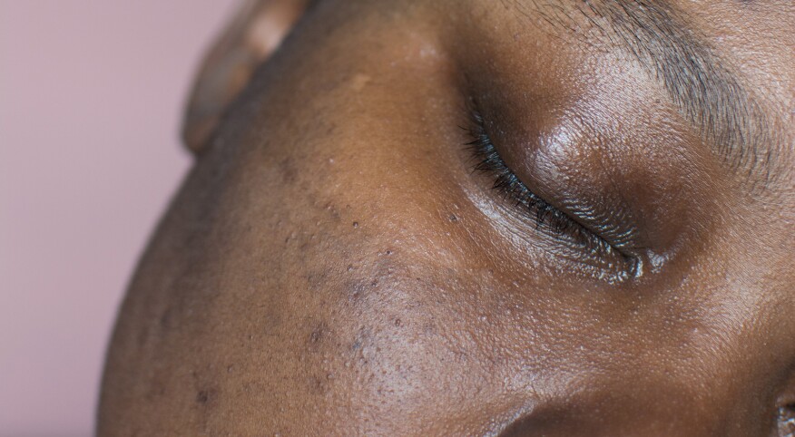 image_of_hyperpigmentation_face_shutterstock_2231302023_1800