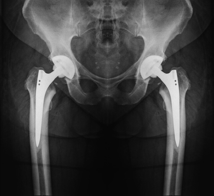 hip-replacements