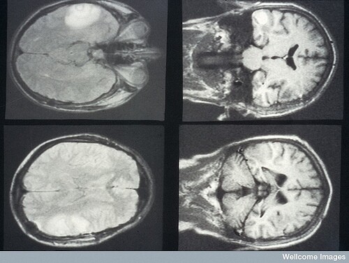 MRI for skin cancer
