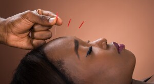 image_of_woman_recieving_acupuncture_GettyImages-614419644_1800
