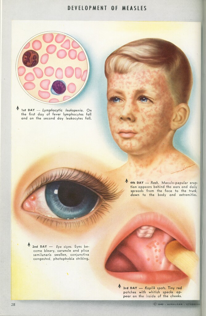 Old poster of measles from doctor's office
