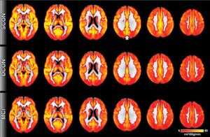 MRI brain scan