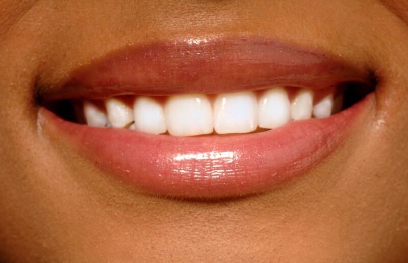 Woman smiles with white teeth