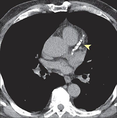 calcium scan